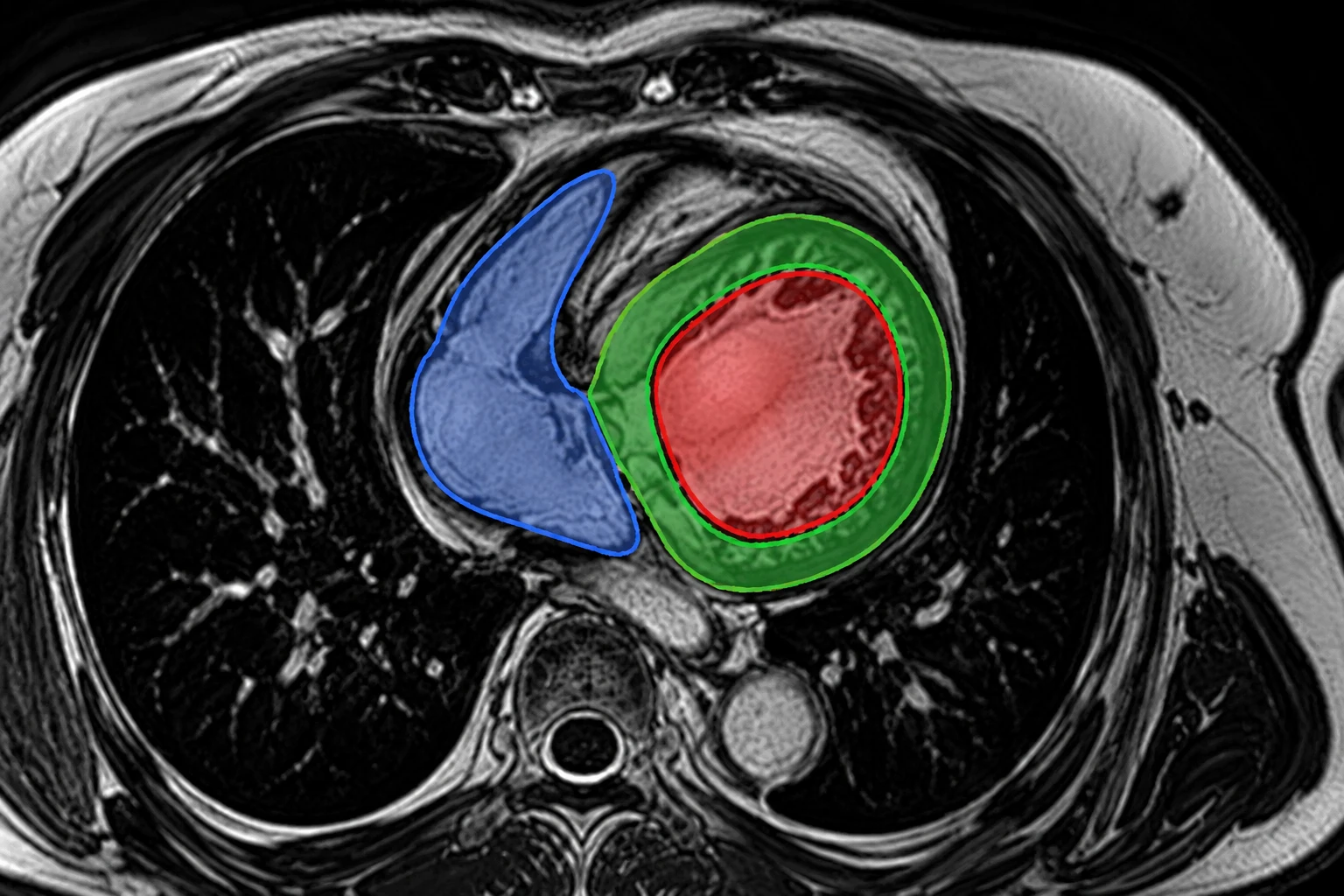 Cardiac MRI