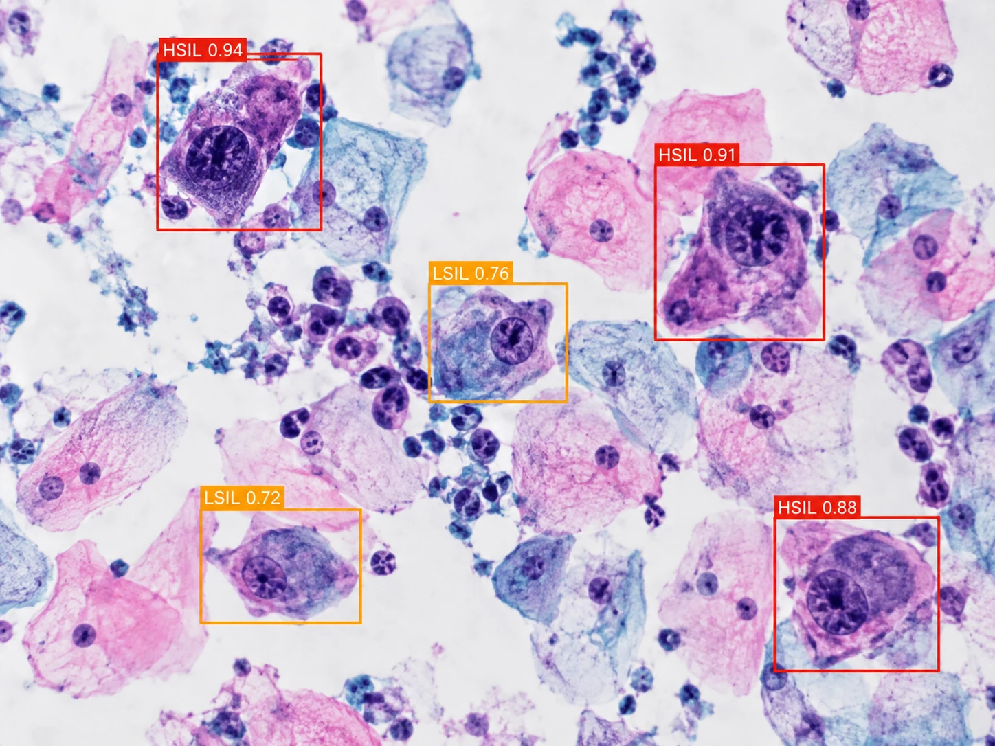 Cervical Cancer