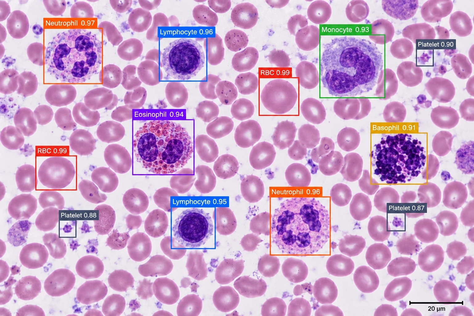 Hematology AI