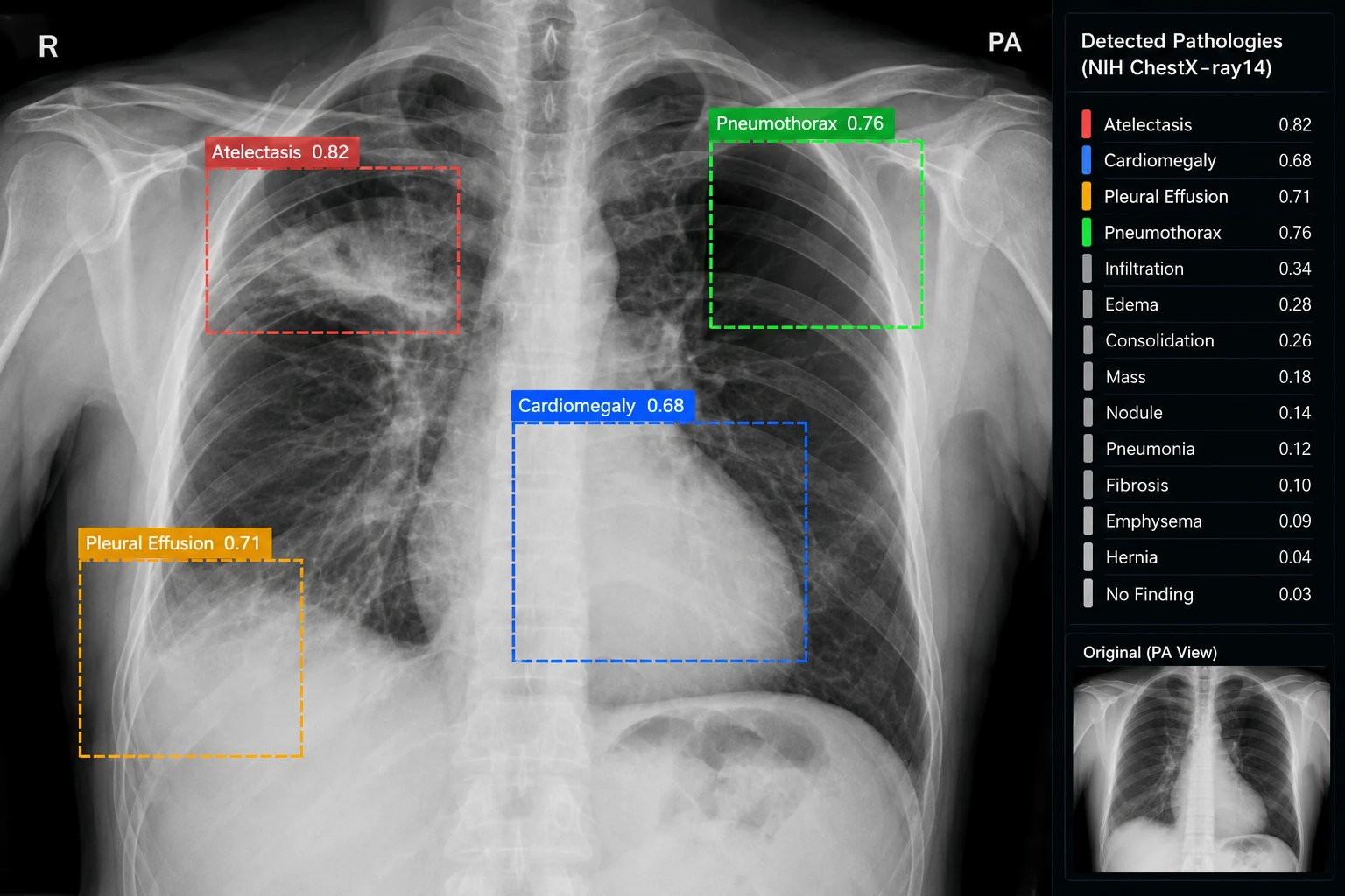 NIH ChestX-ray14