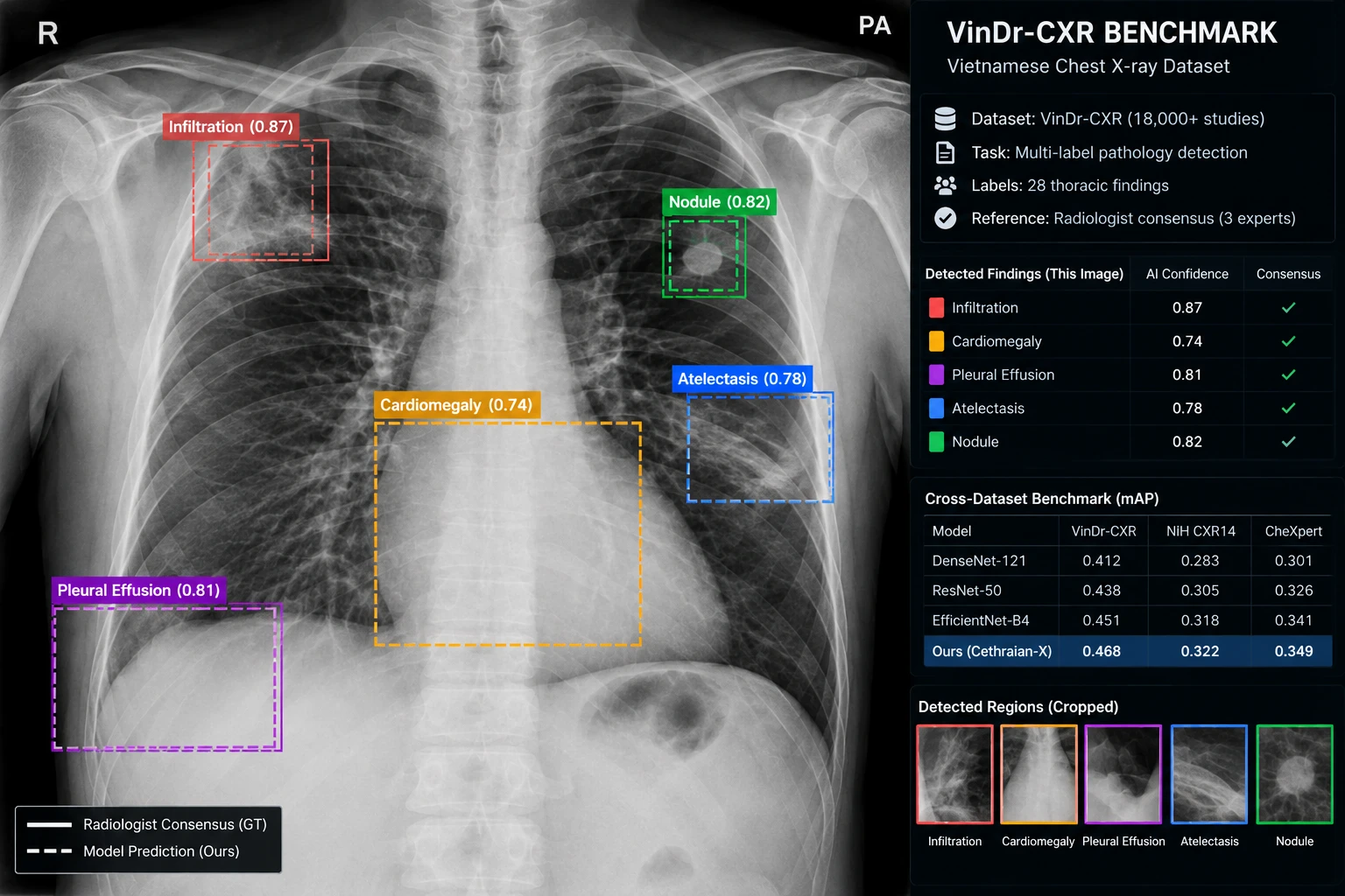 VinDr-CXR